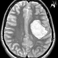 核磁共振成像（MRI）T1WI-T2WI-Flair
